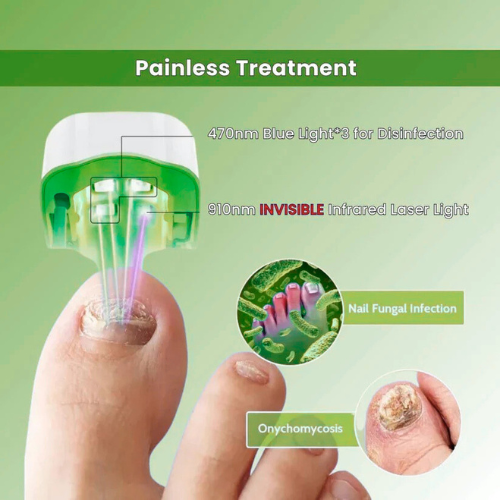 RILO™ - Nail Fungus Laser