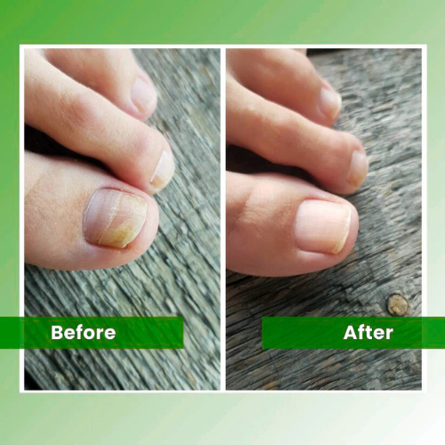 RILO™ - Nail Fungus Laser