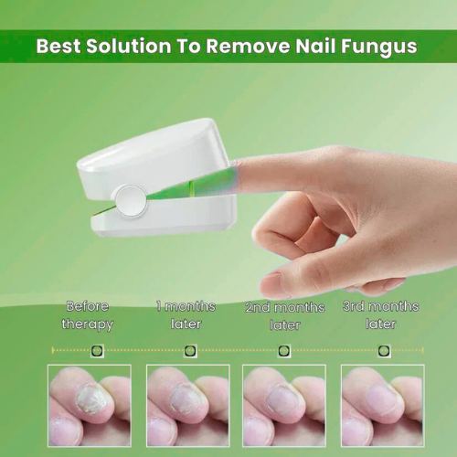 RILO™ - Nail Fungus Laser